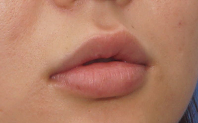 Fillers Before & After Gallery - Patient 231211 - Image 8