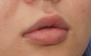 Fillers Before & After Gallery - Patient 231211 - Image 8
