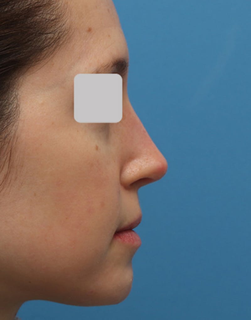 Rhinoplasty Before & After Gallery - Patient 850198 - Image 2