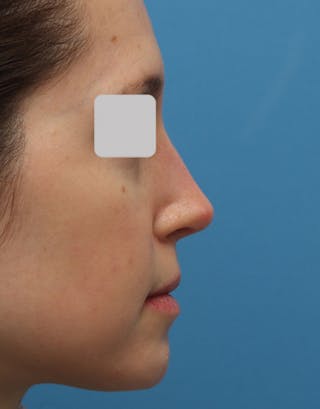Rhinoplasty Before & After Gallery - Patient 135181 - Image 2