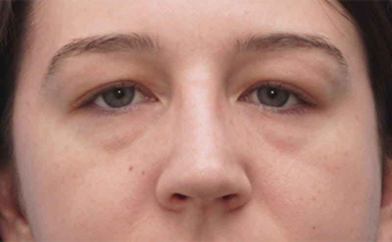 Eyelid Surgery Before & After Gallery - Patient 376763 - Image 1