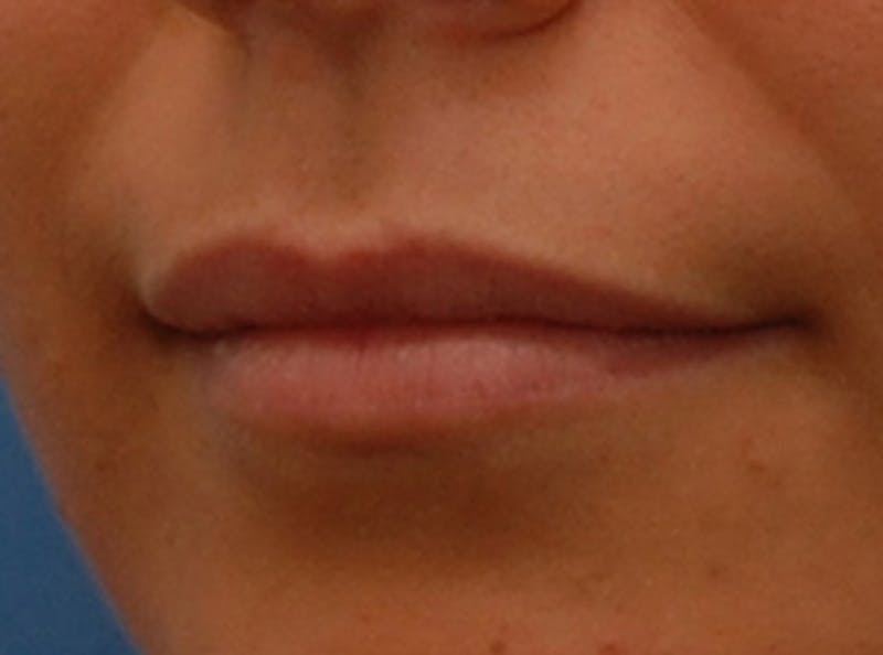 Lip Fillers Before & After Gallery - Patient 135275 - Image 5