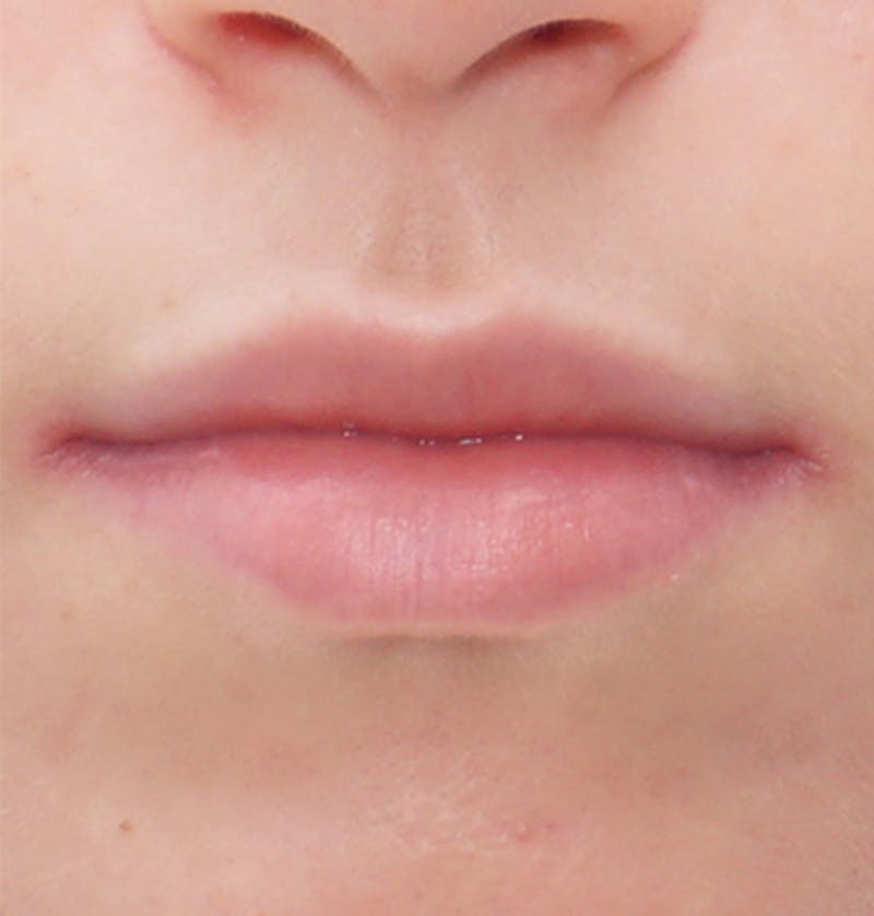Fillers Before & After Gallery - Patient 834989 - Image 1