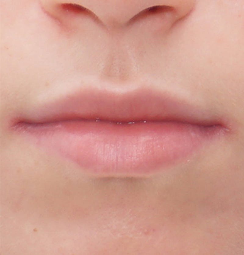 Patient KHHohURkTXSrxgVOgDh3mg - Lip Fillers Before & After Photos