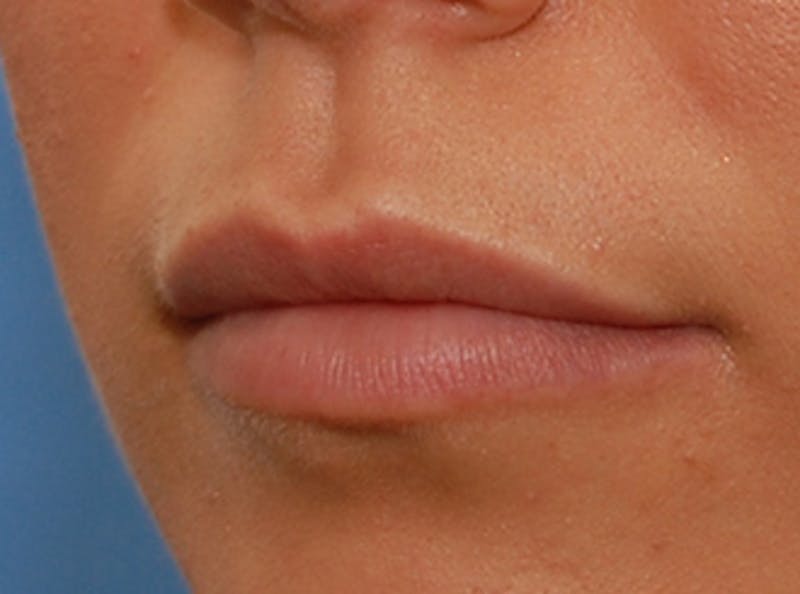 Lip Fillers Before & After Gallery - Patient 135275 - Image 6