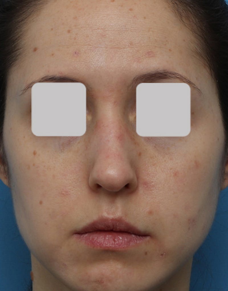 Rhinoplasty Before & After Gallery - Patient 850198 - Image 3