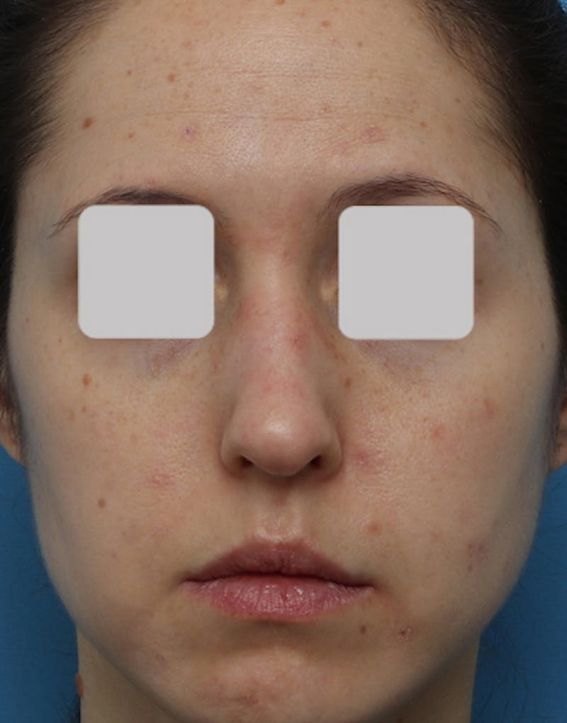 Rhinoplasty  Before & After Gallery - Patient 135181 - Image 3