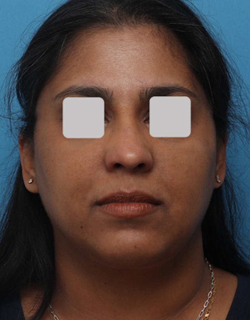 Chin Surgery Before & After Gallery - Patient 240093 - Image 4