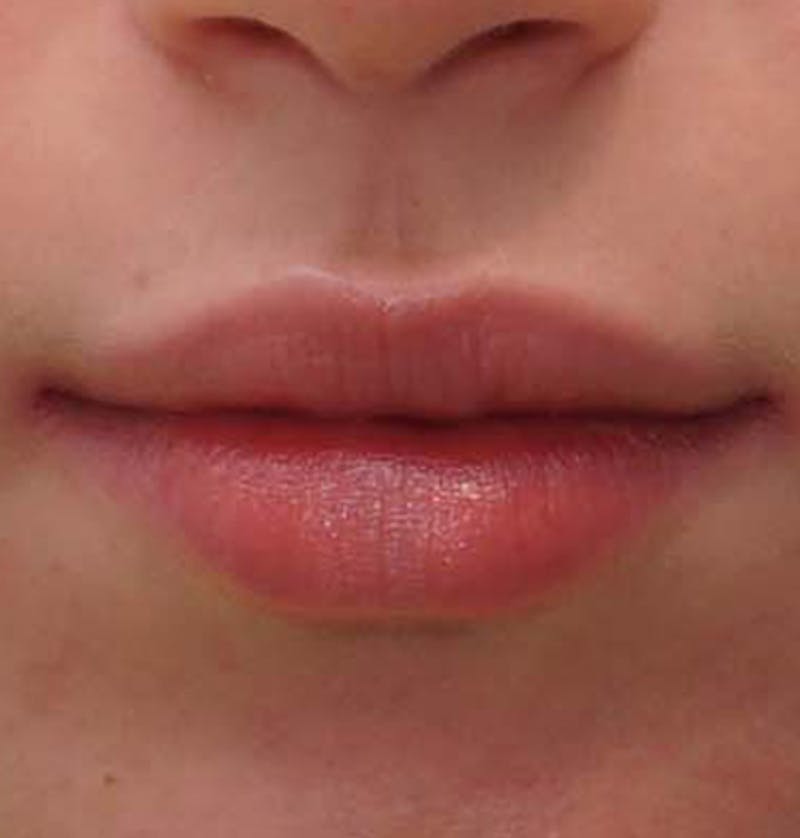 Fillers Before & After Gallery - Patient 834989 - Image 2