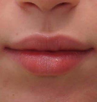 Fillers Before & After Gallery - Patient 834989 - Image 2