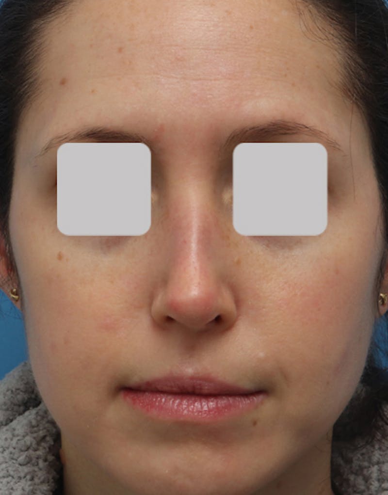 Rhinoplasty Before & After Gallery - Patient 850198 - Image 4