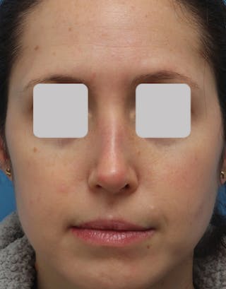 Rhinoplasty Before & After Gallery - Patient 135181 - Image 4