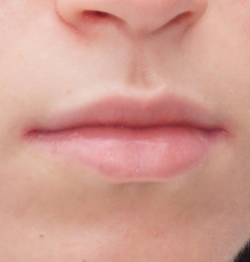 Fillers Before & After Gallery - Patient 834989 - Image 3