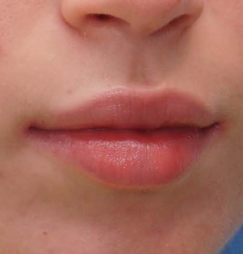 Fillers Before & After Gallery - Patient 834989 - Image 4