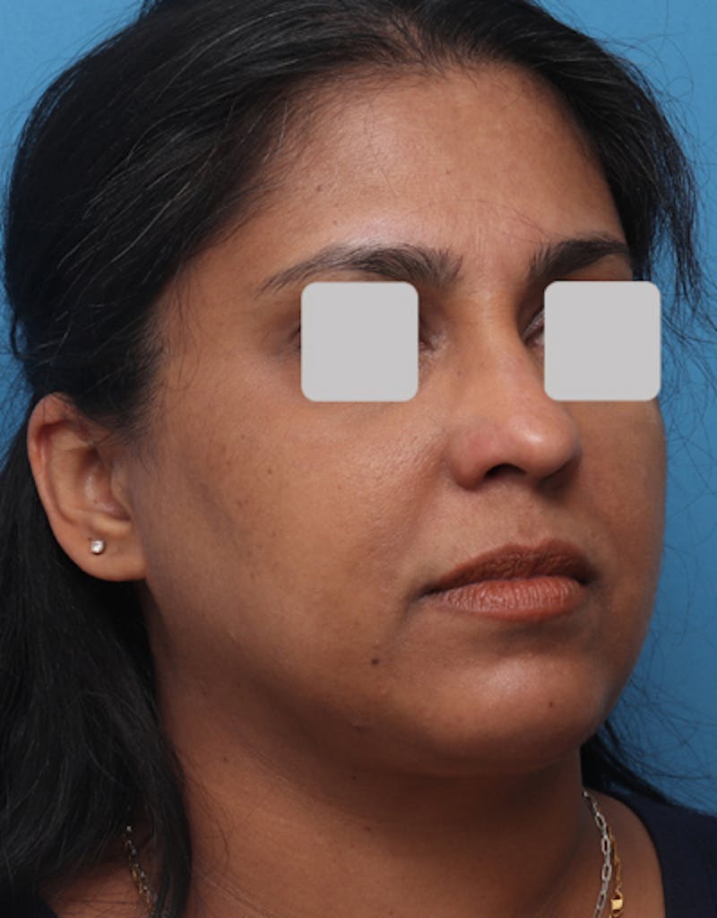 Chin Surgery Before & After Gallery - Patient 240093 - Image 6