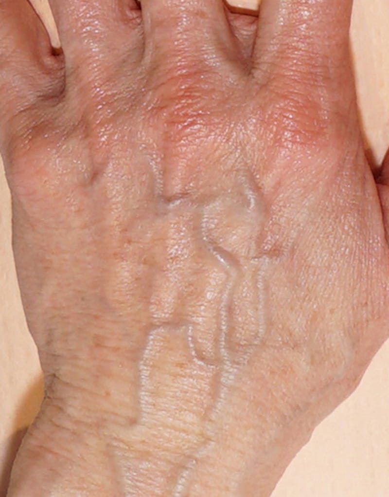 Patient MANTEnl_RdKZ-z5je4zUIQ - Fillers Before & After Photos