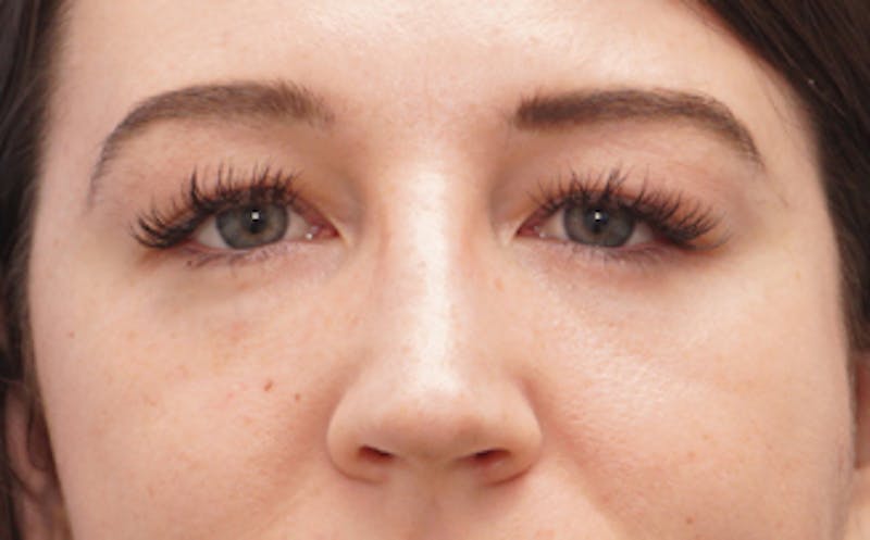 Eyelid Surgery Before & After Gallery - Patient 376763 - Image 2