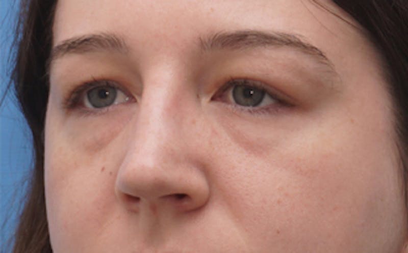 Eyelid Surgery Before & After Gallery - Patient 376763 - Image 3