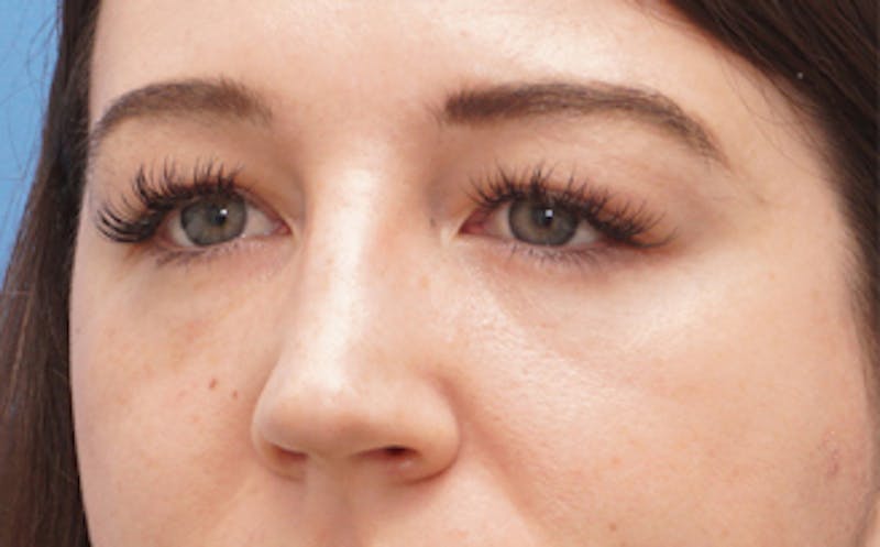 Eyelid Surgery Before & After Gallery - Patient 376763 - Image 4