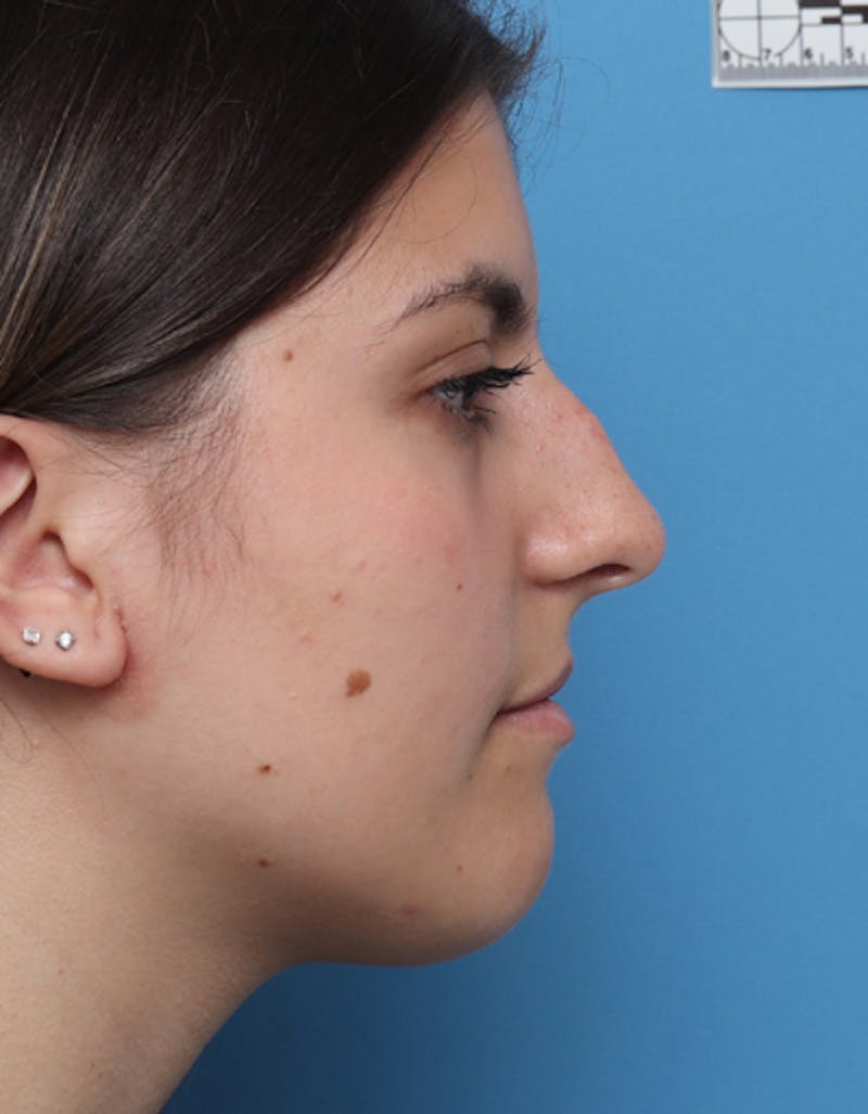 Chin Surgery Before & After Gallery - Patient 298706 - Image 1