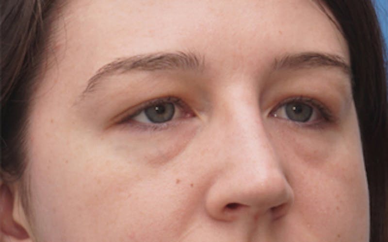 Eyelid Surgery Before & After Gallery - Patient 376763 - Image 5