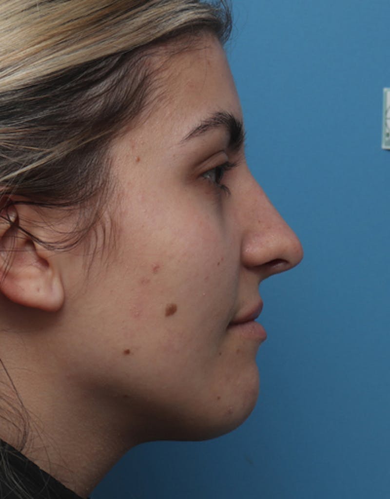 Chin Surgery Before & After Gallery - Patient 298706 - Image 2