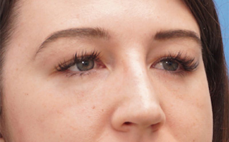 Eyelid Surgery Before & After Gallery - Patient 376763 - Image 6