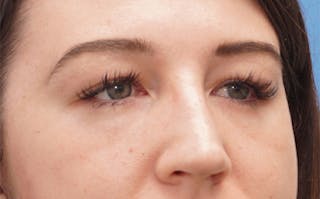 Eyelid Surgery Before & After Gallery - Patient 376763 - Image 6