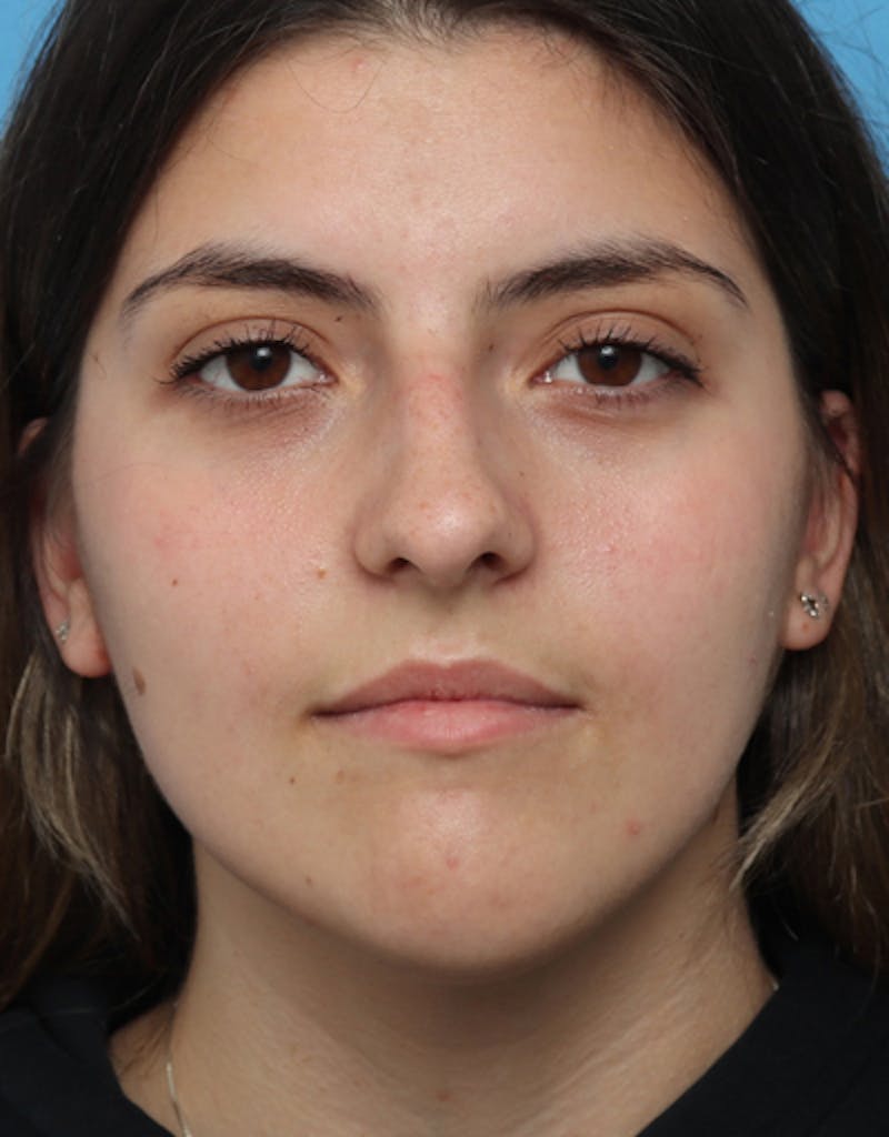 Chin Surgery Before & After Gallery - Patient 298706 - Image 3