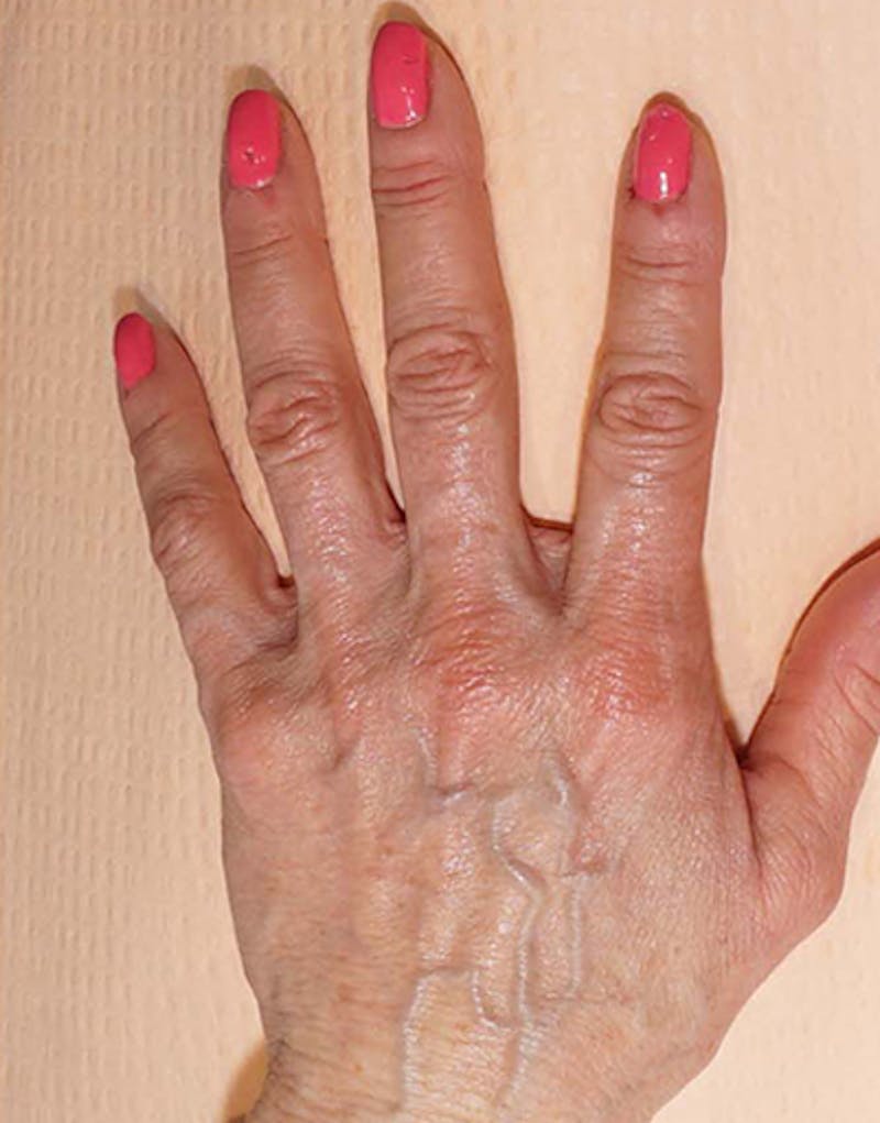 Patient QeFfNQEqRCiHRiNfB833FA - Fillers Before & After Photos