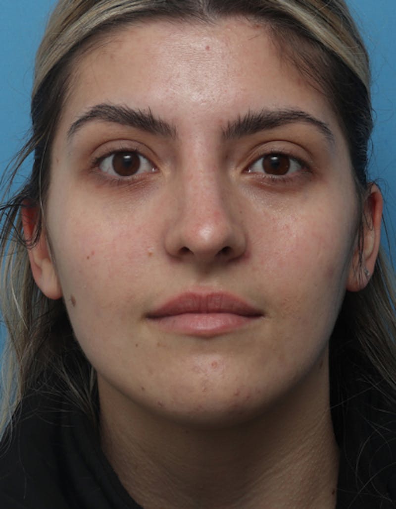 Chin Surgery Before & After Gallery - Patient 298706 - Image 4