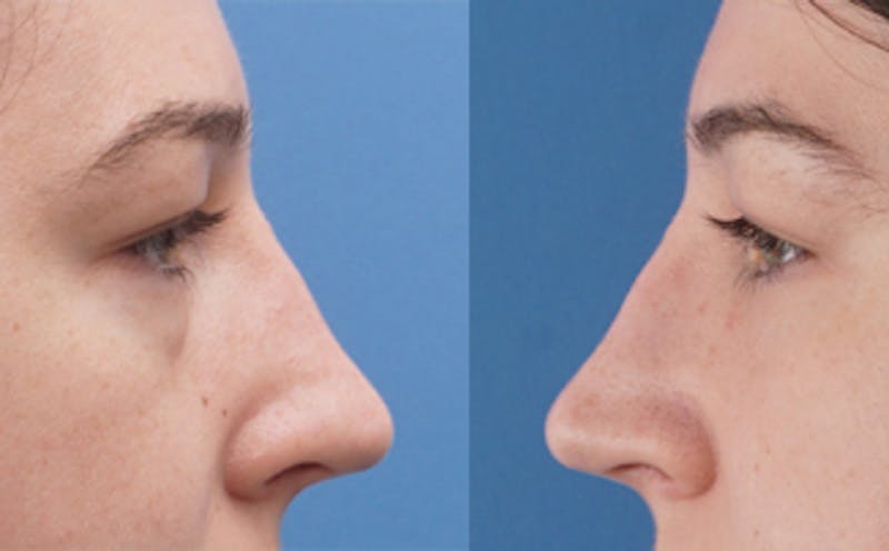 Eyelid Surgery Before & After Gallery - Patient 376763 - Image 7