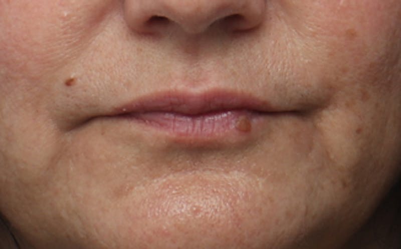 Lip Fillers Before & After Gallery - Patient 164605 - Image 1