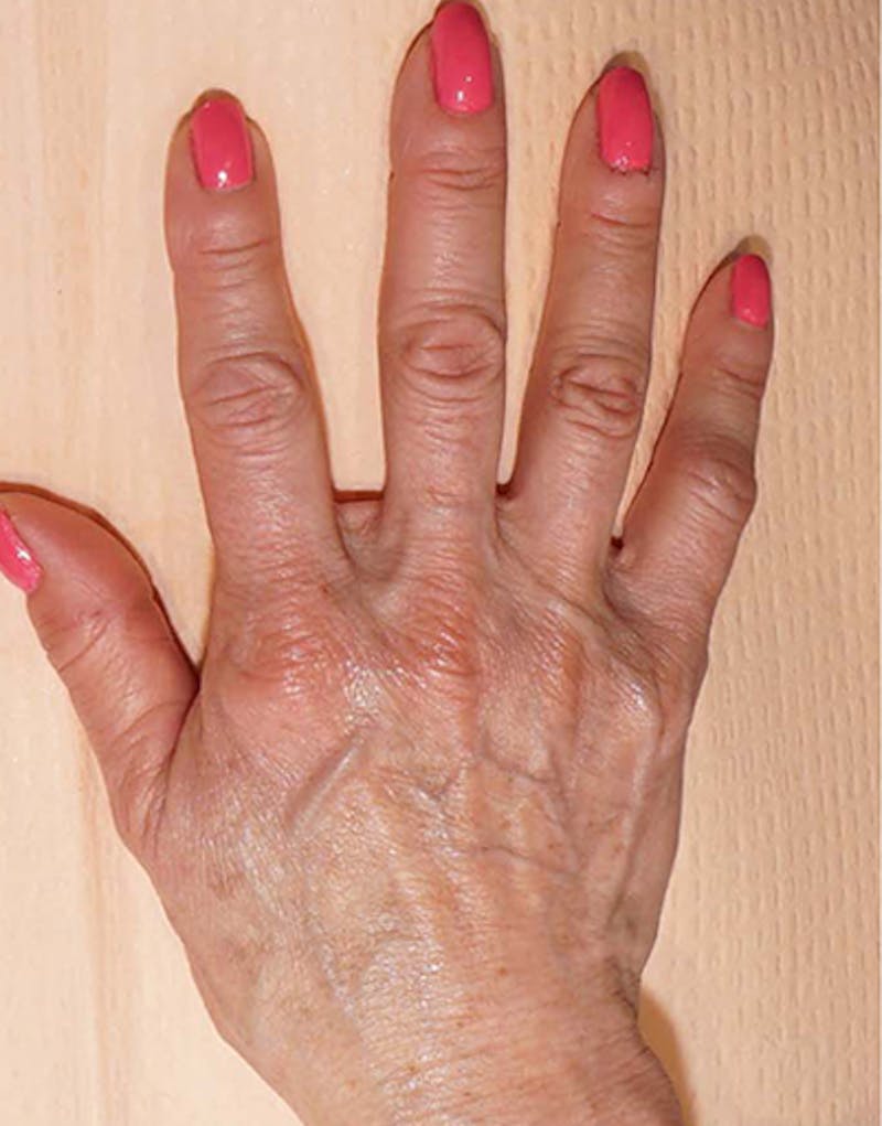 Fillers Before & After Gallery - Patient 332404 - Image 3