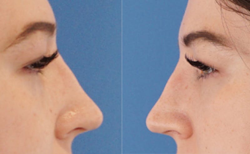 Eyelid Surgery Before & After Gallery - Patient 376763 - Image 8