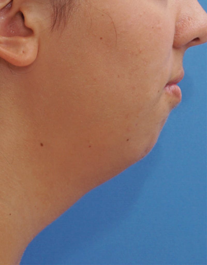 FaceTite Before & After Gallery - Patient 161350 - Image 1