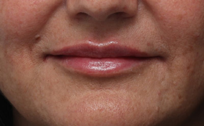 Lip Fillers Before & After Gallery - Patient 164605 - Image 2