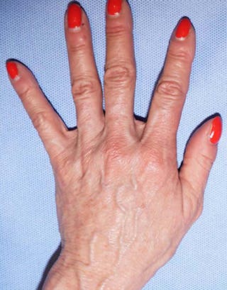 Fillers Before & After Gallery - Patient 332404 - Image 2