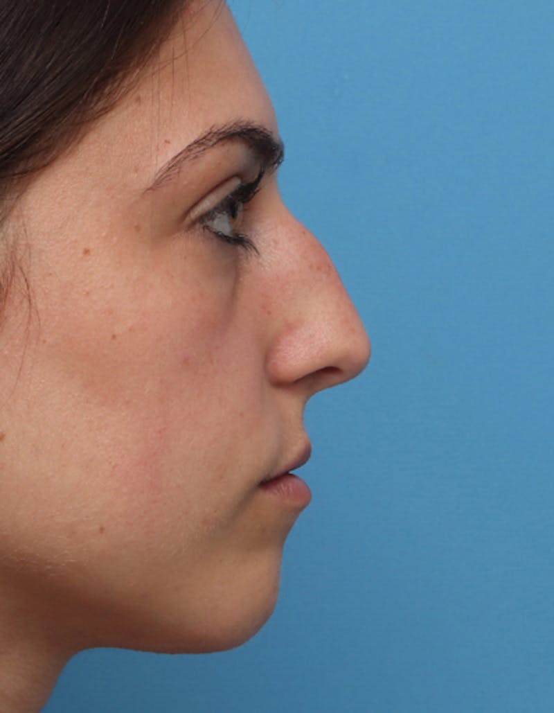 Rhinoplasty Before & After Gallery - Patient 272052 - Image 1