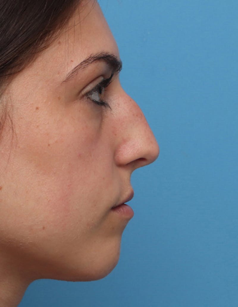 Patient foksSk3pTMeFaFOhnvfJvA - Rhinoplasty Before & After Photos