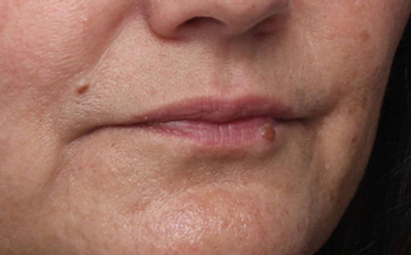 Lip Fillers Before & After Gallery - Patient 164605 - Image 3