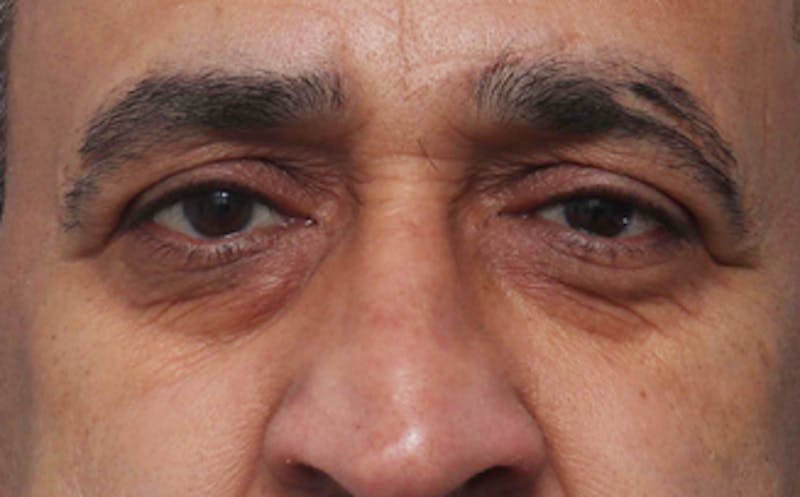 Eyelid Surgery Before & After Gallery - Patient 124571 - Image 1