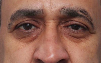 Eyelid Surgery Before & After Gallery - Patient 124571 - Image 1