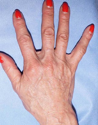 Fillers Before & After Gallery - Patient 332404 - Image 4