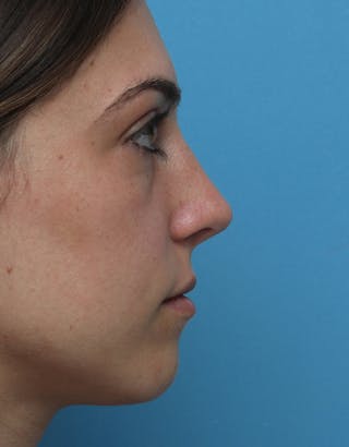Rhinoplasty Before & After Gallery - Patient 364495 - Image 2
