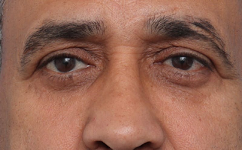 Eyelid Surgery Before & After Gallery - Patient 124571 - Image 2