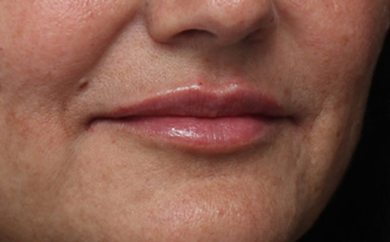 Lip Fillers Before & After Gallery - Patient 164605 - Image 4