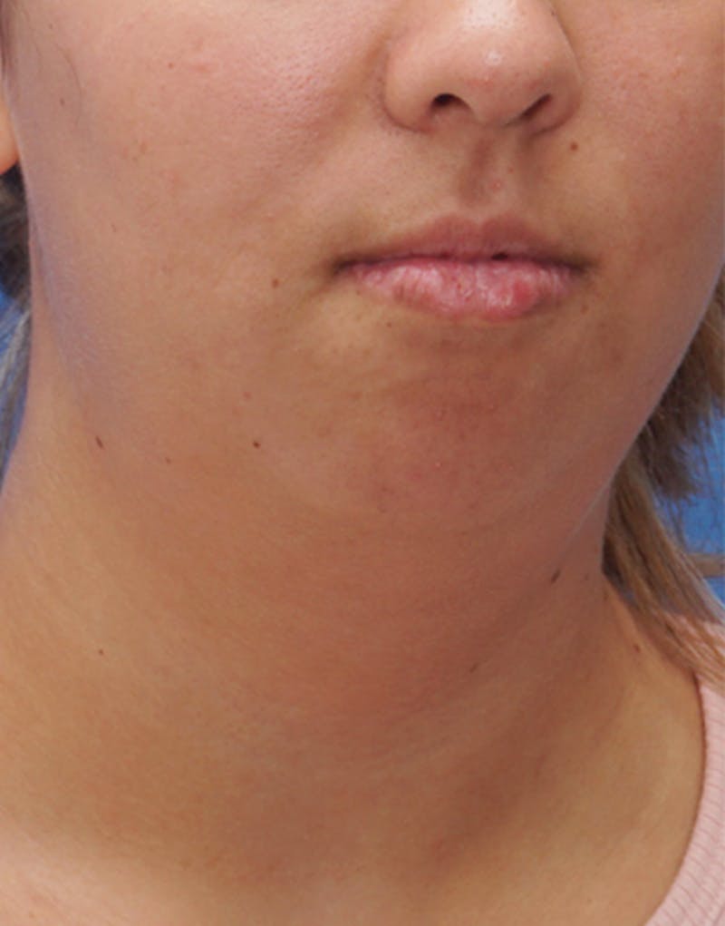 FaceTite Before & After Gallery - Patient 161350 - Image 3