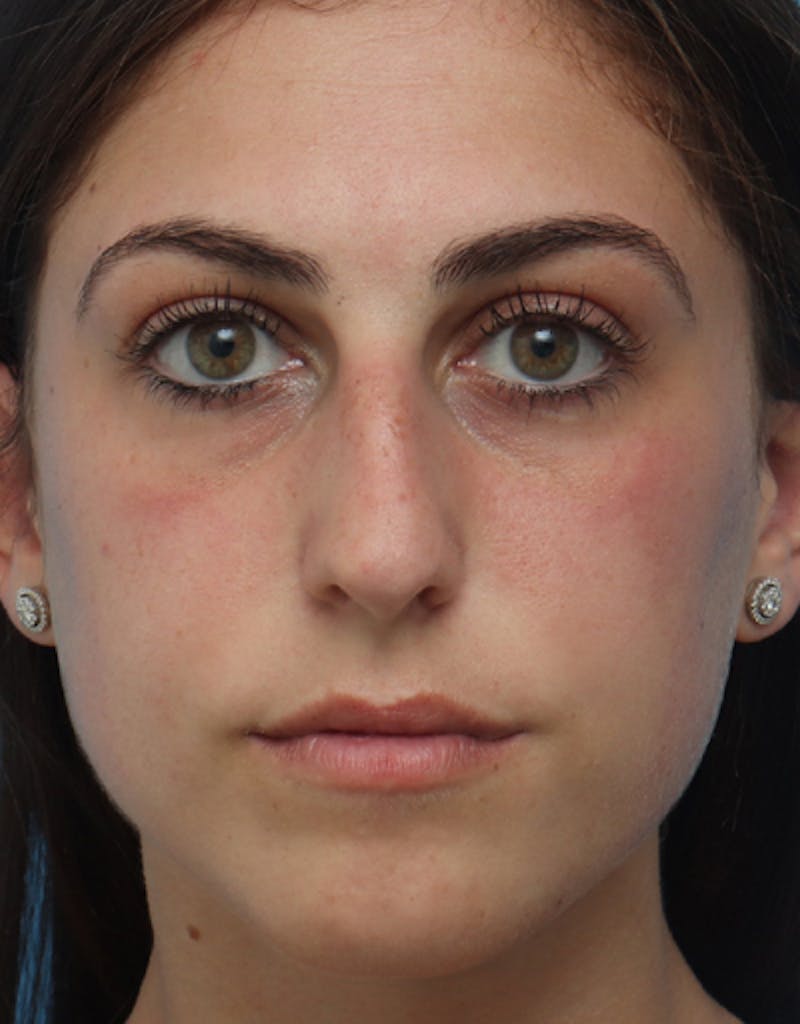 Rhinoplasty Before & After Gallery - Patient 272052 - Image 3