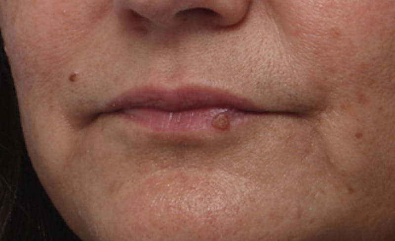 Lip Fillers Before & After Gallery - Patient 164605 - Image 5